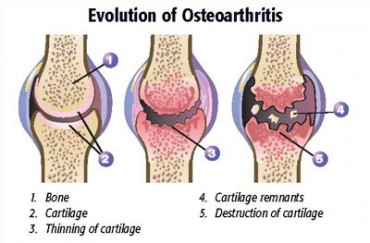 Osteoarthritis Osteoarthritis