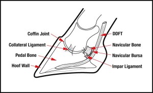 Accessory Navicular