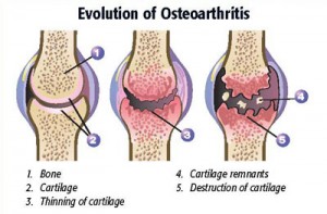 osteoarthritis.evolution