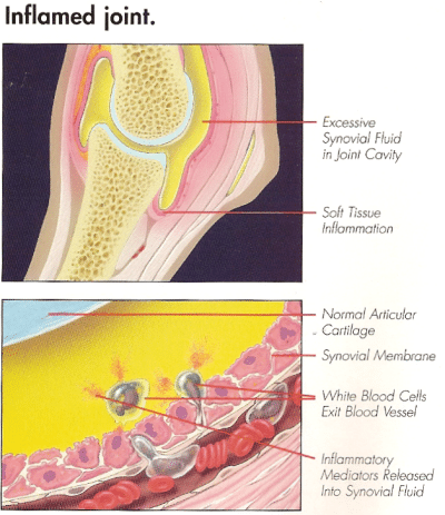 Boala artrozică a genunchiului: injecțiile intraarticulare cu corticosteroizi